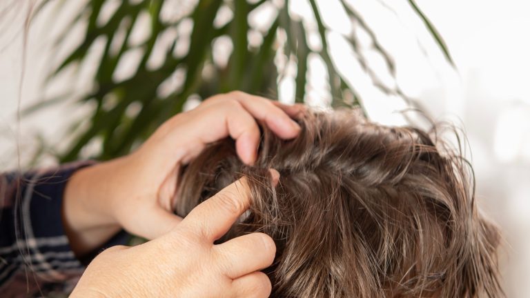 How Can You Tell Dandruff From Lice Nits at Home?