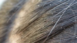 Macro close-up of a single tan-colored lice egg cemented to a strand of hair, illustrating the honey/amber color of a fresh, viable nit during home screening.