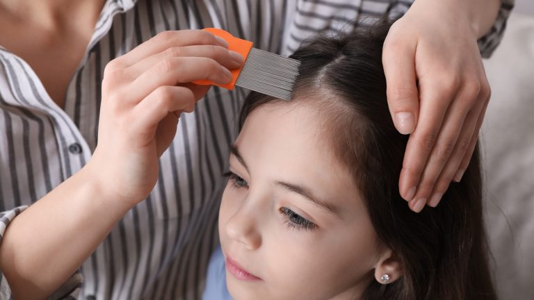 A Lice Case Is Over When Two Comb Checks Come Back Clean